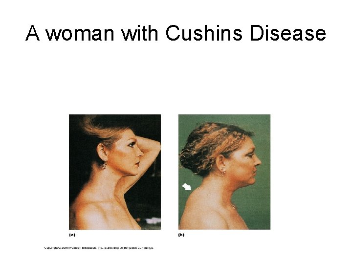 A woman with Cushins Disease 