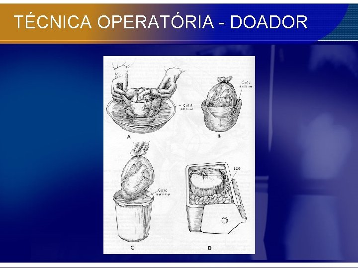 TÉCNICA OPERATÓRIA - DOADOR 