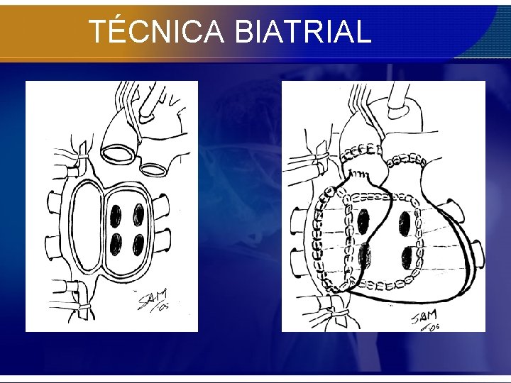 TÉCNICA BIATRIAL 