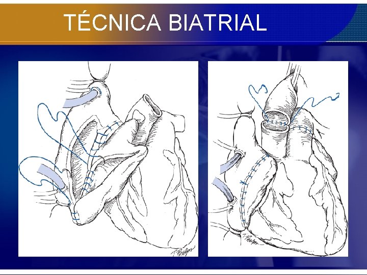 TÉCNICA BIATRIAL 