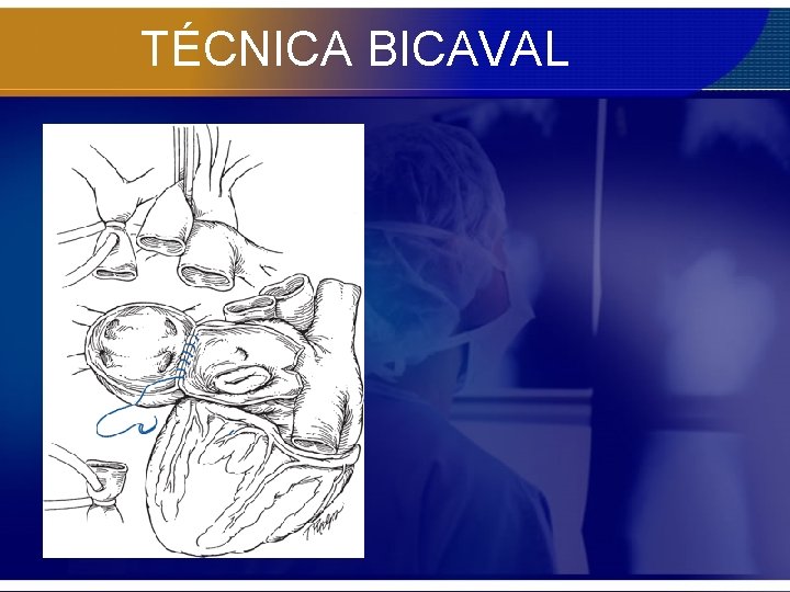 TÉCNICA BICAVAL 