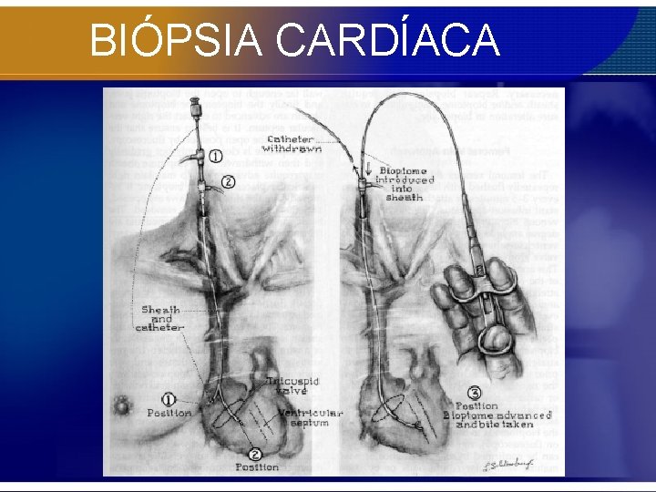 BIÓPSIA CARDÍACA 