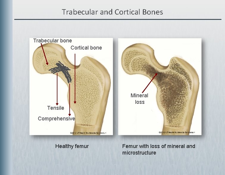 Trabecular and Cortical Bones Trabecular bone Cortical bone Mineral loss Tensile Comprehensive Healthy femur