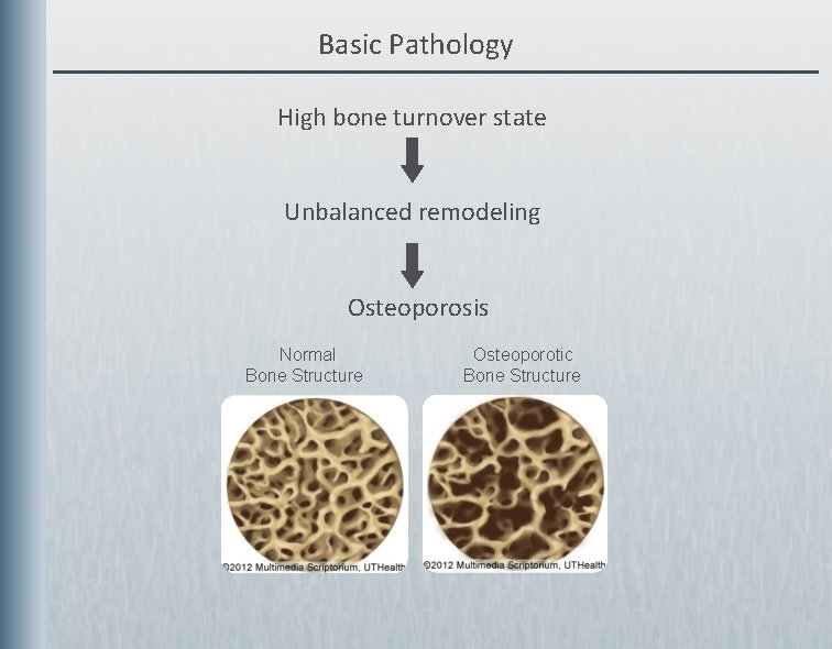 Basic Pathology High bone turnover state Unbalanced remodeling Osteoporosis Normal Bone Structure Osteoporotic Bone