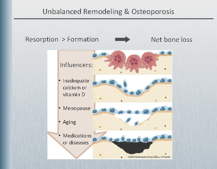 Unbalanced Remodeling & Osteoporosis Resorption > Formation Influencers: • Inadequate calcium or vitamin D