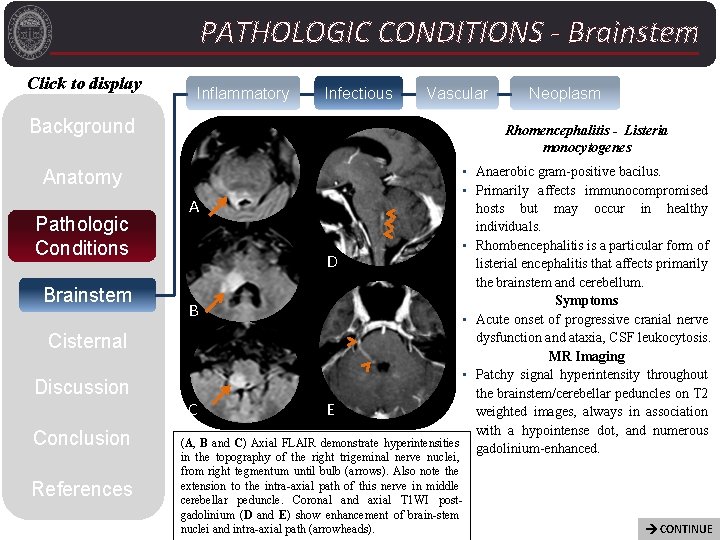PATHOLOGIC CONDITIONS - Brainstem Click to display Inflammatory Infectious Vascular Background Anatomy Pathologic Conditions