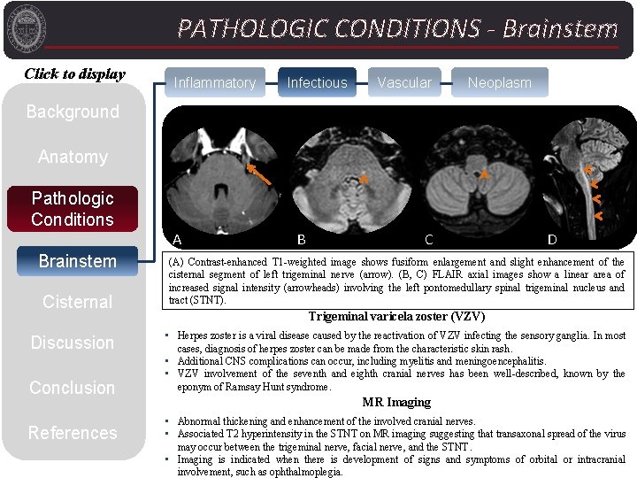 PATHOLOGIC CONDITIONS - Brainstem Click to display Inflammatory Infectious Vascular Neoplasm Background Anatomy Pathologic