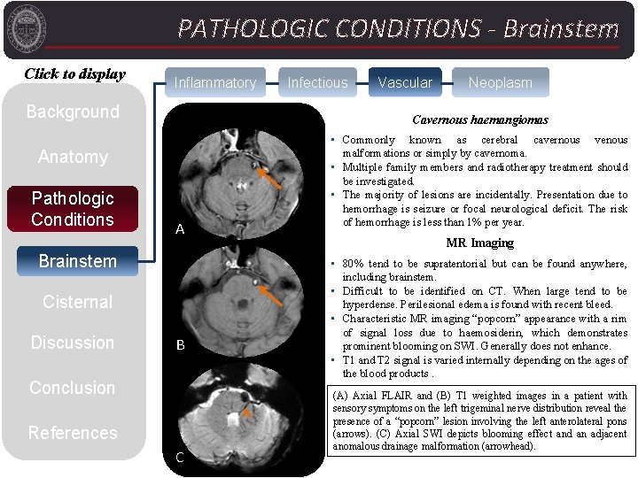 PATHOLOGIC CONDITIONS - Brainstem Click to display Inflammatory Background A Brainstem Cisternal Discussion Vascular