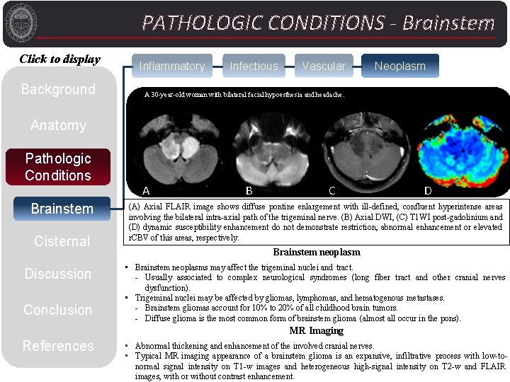 PATHOLOGIC CONDITIONS - Brainstem Click to display Background Inflammatory Infectious Vascular Neoplasm A 30