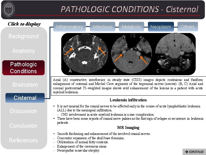 PATHOLOGIC CONDITIONS - Cisternal Click to display Inflammatory Infectious Metabolic Neoplasm Others Background Anatomy