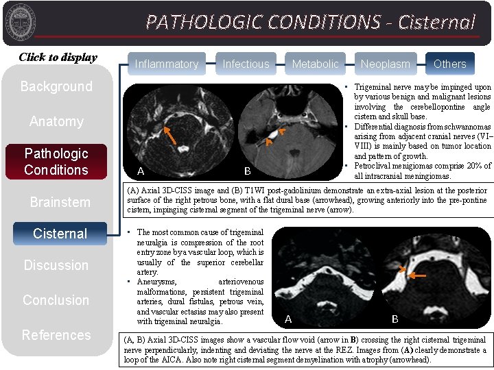 PATHOLOGIC CONDITIONS - Cisternal Click to display Inflammatory Infectious Metabolic Background Brainstem Cisternal Discussion