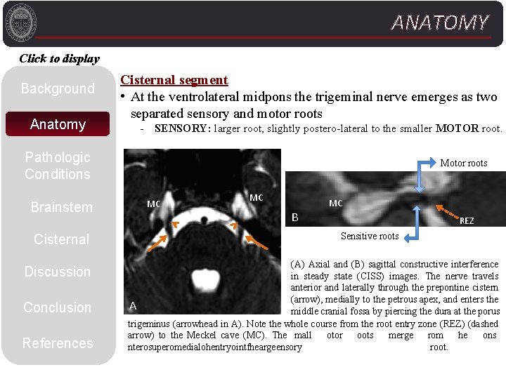 ANATOMY Click to display Background Anatomy Cisternal segment • At the ventrolateral midpons the