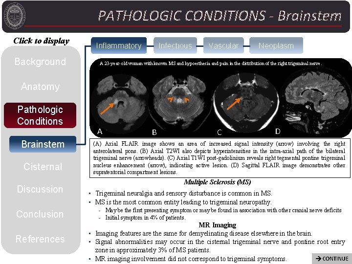 PATHOLOGIC CONDITIONS - Brainstem Click to display Background Inflammatory Infectious Vascular Neoplasm A 23