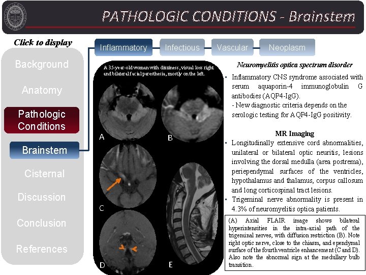 PATHOLOGIC CONDITIONS - Brainstem Click to display Background Inflammatory Infectious A 35 -year-old woman