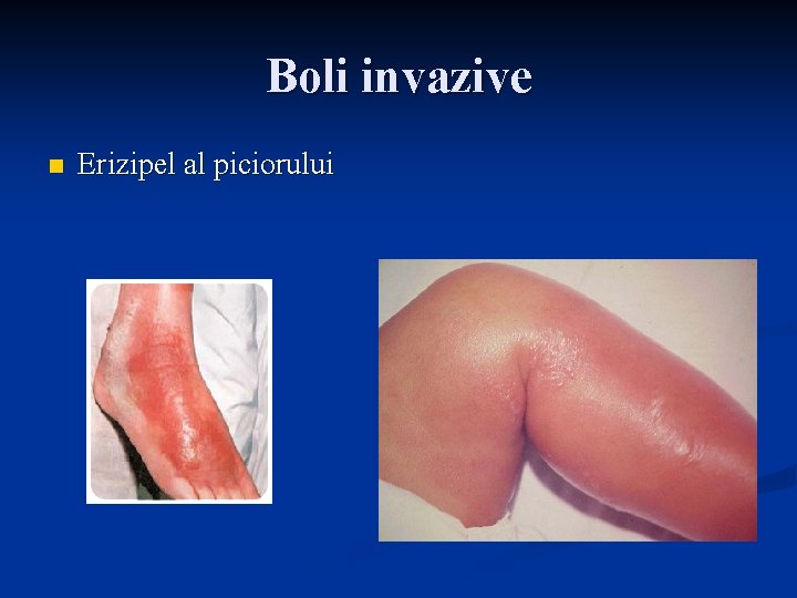 Boli invazive n Erizipel al piciorului 
