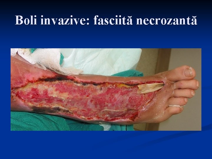 Boli invazive: fasciită necrozantă 
