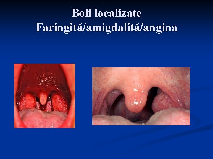 Boli localizate Faringită/amigdalită/angina 