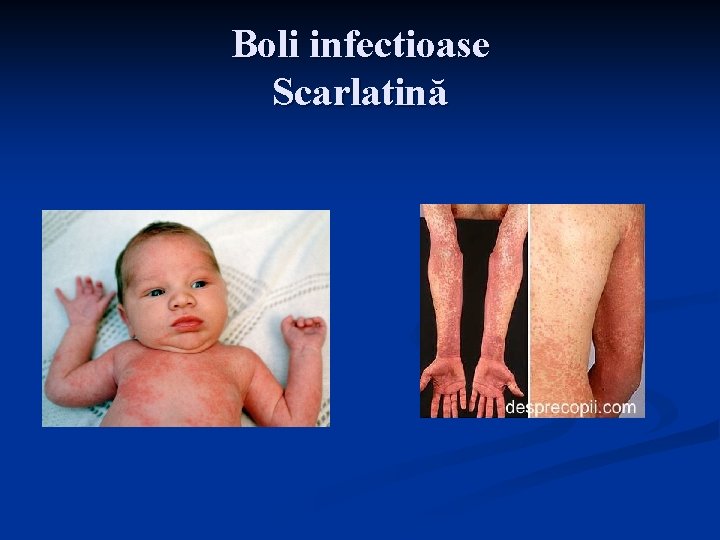 Boli infectioase Scarlatină 
