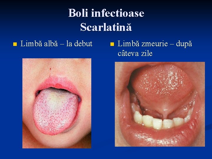 Boli infectioase Scarlatină n Limbă albă – la debut n Limbă zmeurie – după