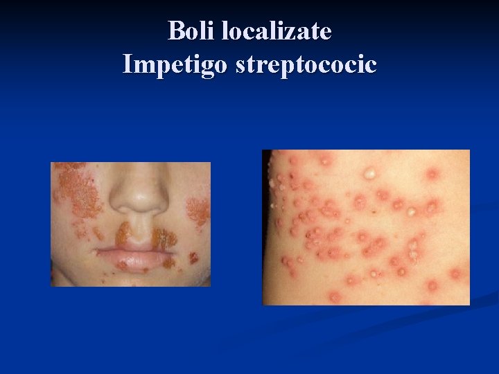 Boli localizate Impetigo streptococic 
