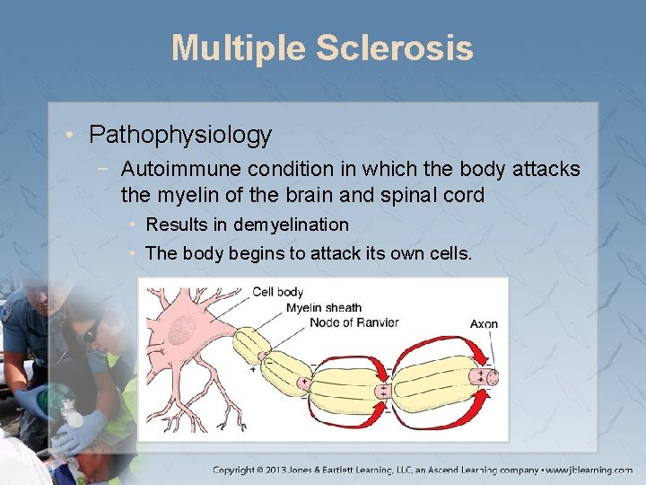 Multiple Sclerosis • Pathophysiology − Autoimmune condition in which the body attacks the myelin