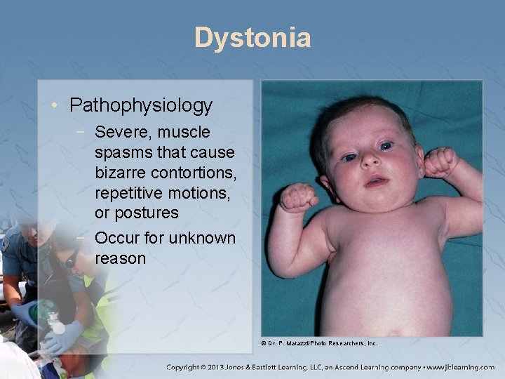 Dystonia • Pathophysiology − Severe, muscle spasms that cause bizarre contortions, repetitive motions, or