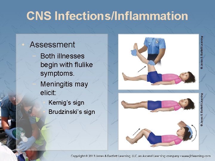 − Both illnesses begin with flulike symptoms. − Meningitis may elicit: • Kernig’s sign