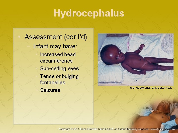 Hydrocephalus • Assessment (cont’d) − Infant may have: • Increased head circumference • Sun-setting