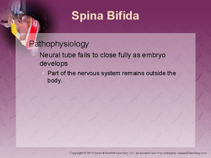 Spina Bifida • Pathophysiology − Neural tube fails to close fully as embryo develops