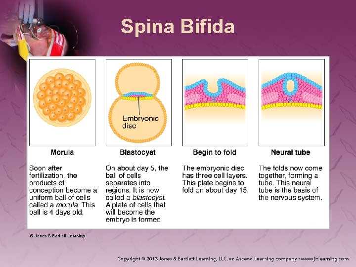 Spina Bifida © Jones & Bartlett Learning 