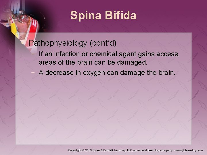 Spina Bifida • Pathophysiology (cont’d) − If an infection or chemical agent gains access,