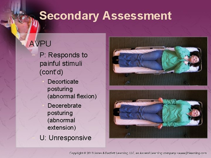 Secondary Assessment • AVPU − P: Responds to painful stimuli (cont’d) • Decorticate posturing