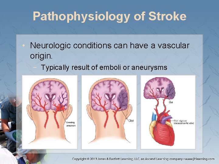 Pathophysiology of Stroke • Neurologic conditions can have a vascular origin. − Typically result