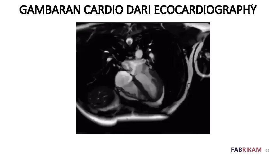 GAMBARAN CARDIO DARI ECOCARDIOGRAPHY FABRIKAM 32 