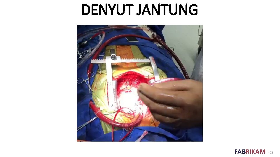 DENYUT JANTUNG FABRIKAM 33 