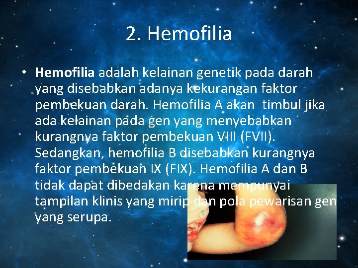 2. Hemofilia • Hemofilia adalah kelainan genetik pada darah yang disebabkan adanya kekurangan faktor