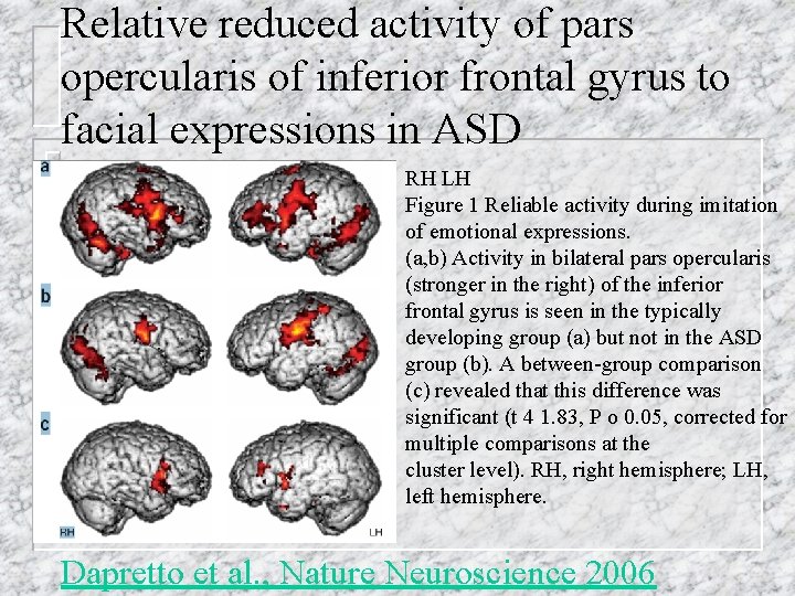 Relative reduced activity of pars opercularis of inferior frontal gyrus to facial expressions in
