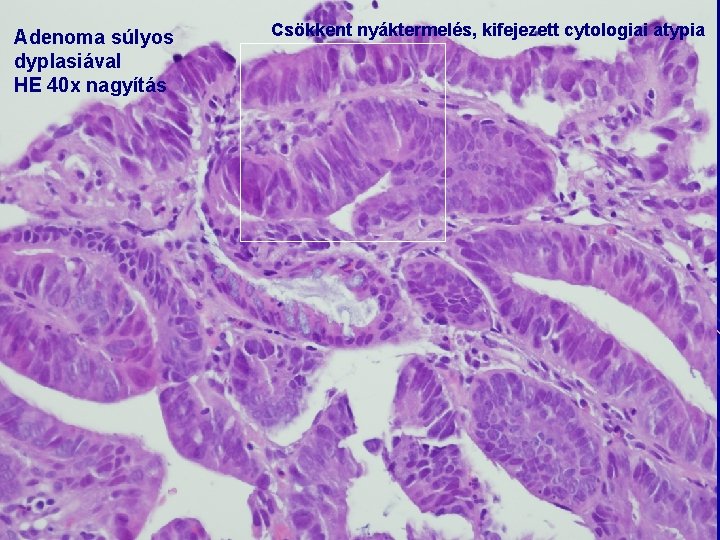 adenoma vastagbél