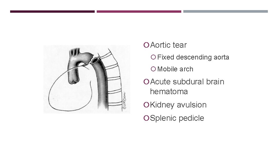 DECELERATION INJURY Aortic tear Fixed descending aorta Mobile arch Acute subdural brain hematoma Kidney