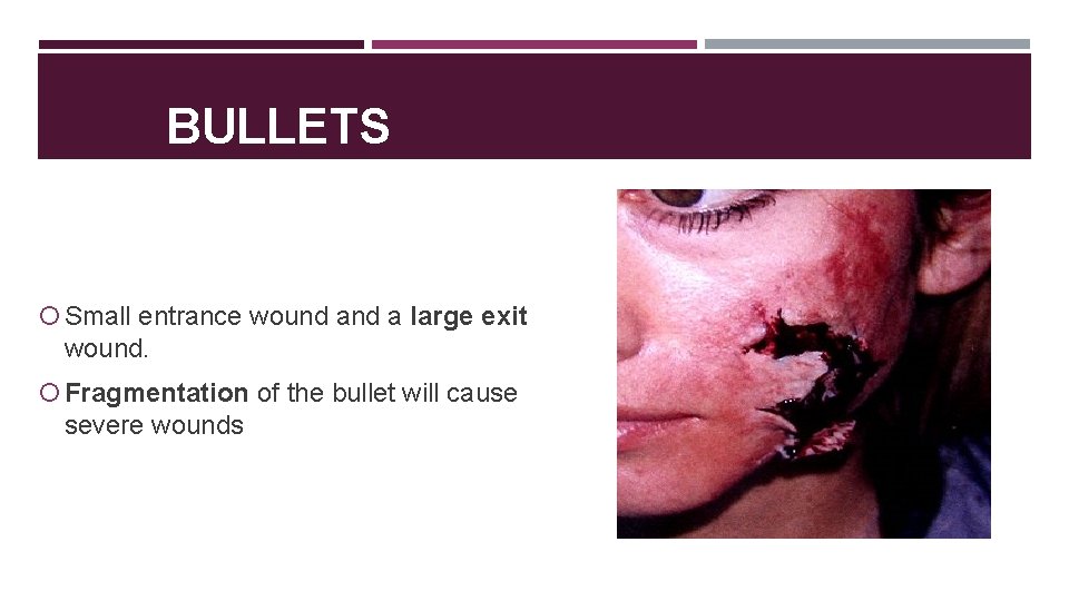 BULLETS Small entrance wound a large exit wound. Fragmentation of the bullet will cause