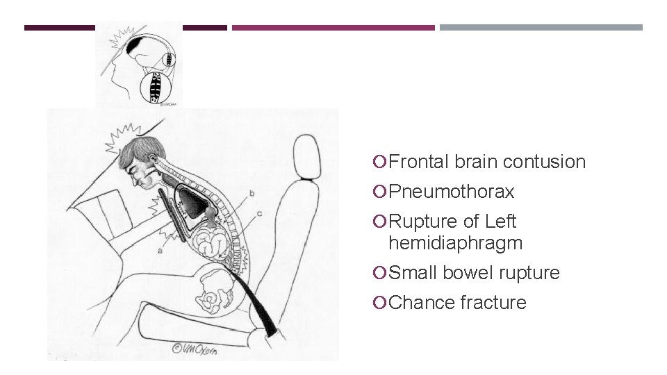 COMPRESSION INJURY Frontal brain contusion Pneumothorax Rupture of Left hemidiaphragm Small bowel rupture Chance