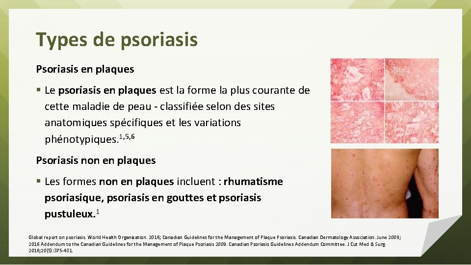 Types de psoriasis Psoriasis en plaques § Le psoriasis en plaques est la forme