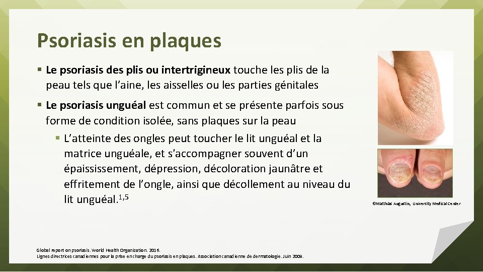 Psoriasis en plaques § Le psoriasis des plis ou intertrigineux touche les plis de