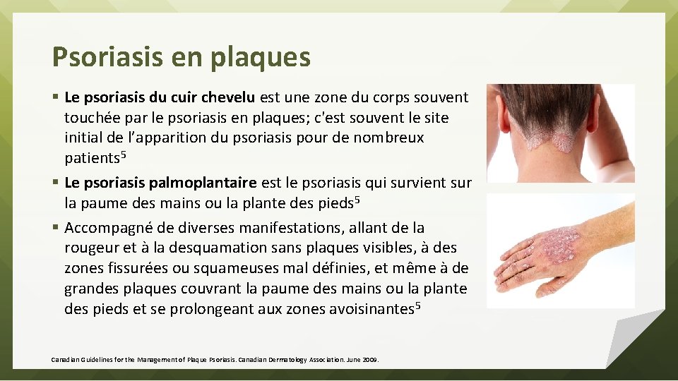 Psoriasis en plaques § Le psoriasis du cuir chevelu est une zone du corps