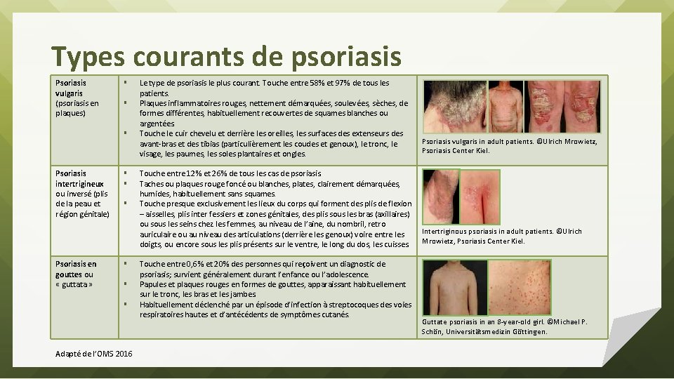 Types courants de psoriasis Psoriasis vulgaris (psoriasis en plaques) § § § Psoriasis intertrigineux