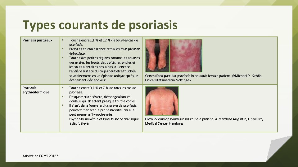 Types courants de psoriasis Psoriasis pustuleux § § § Psoriasis érythrodermique § § §