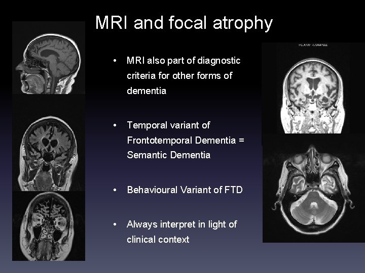 MRI and focal atrophy • MRI also part of diagnostic criteria for other forms