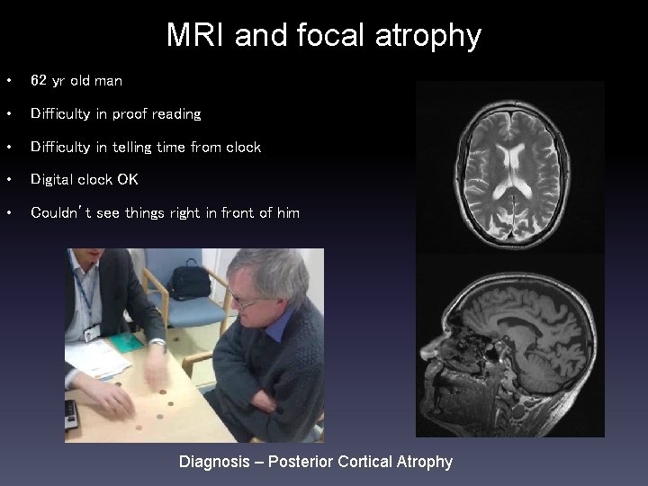 MRI and focal atrophy • 62 yr old man • Difficulty in proof reading