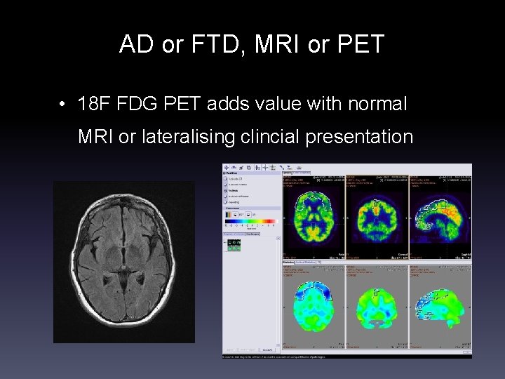 AD or FTD, MRI or PET • 18 F FDG PET adds value with