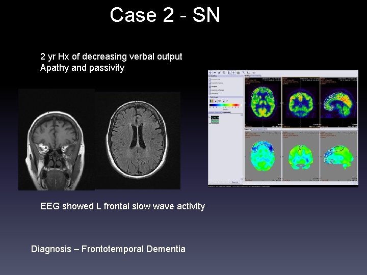 Case 2 - SN 2 yr Hx of decreasing verbal output Apathy and passivity